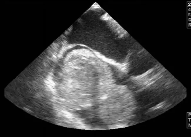 Transoesophageal Atrial Pacing : 经食管心房起搏