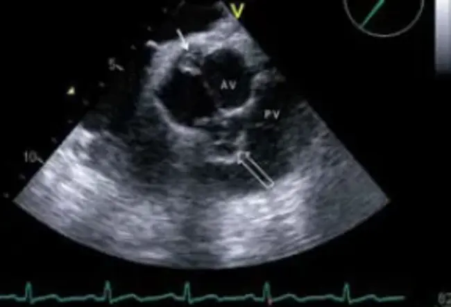 transoesophageal echocardiography : 经食道超声心动图