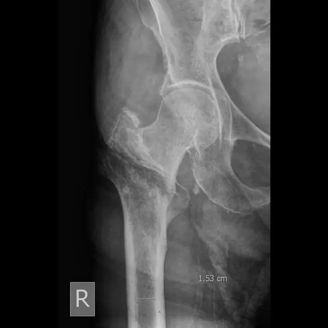 Transtrochanteric Rotational Osteotomy : 经转子旋转截骨术