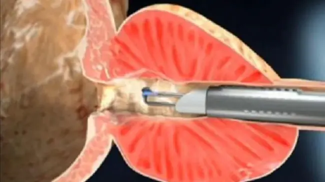 transurethral coagulation : 经尿道电凝