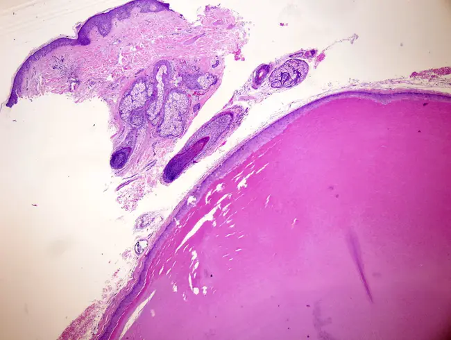 Trichilemmal Cysts : 三回肠囊肿