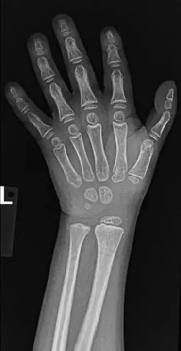 triphalangeal thumb : 下丘脑拇指