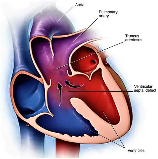 Truncus Arteriosus Communis : 总动脉干