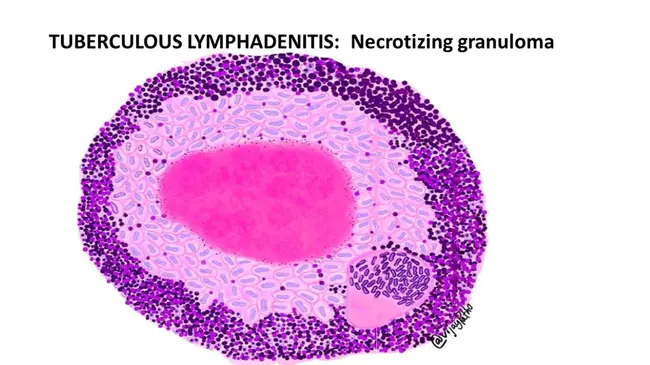 Tuberculous Pleuritis : 结核性胸膜炎