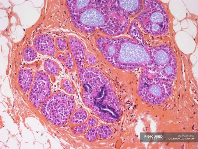 Tubular Carcinoma : 管状癌