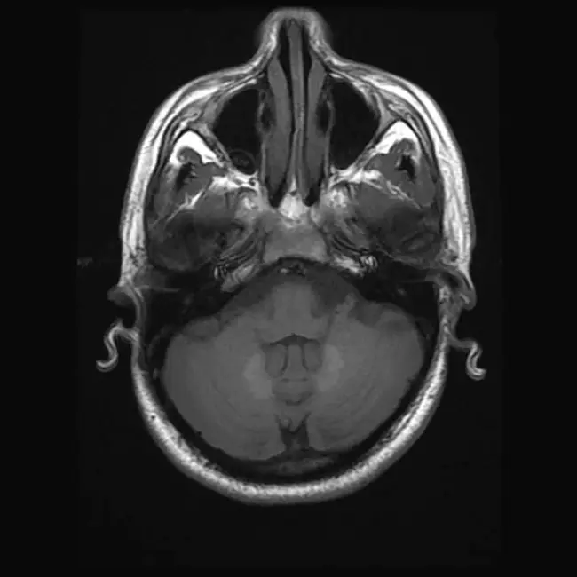 Tumoural Calcinosis : 肿瘤钙化