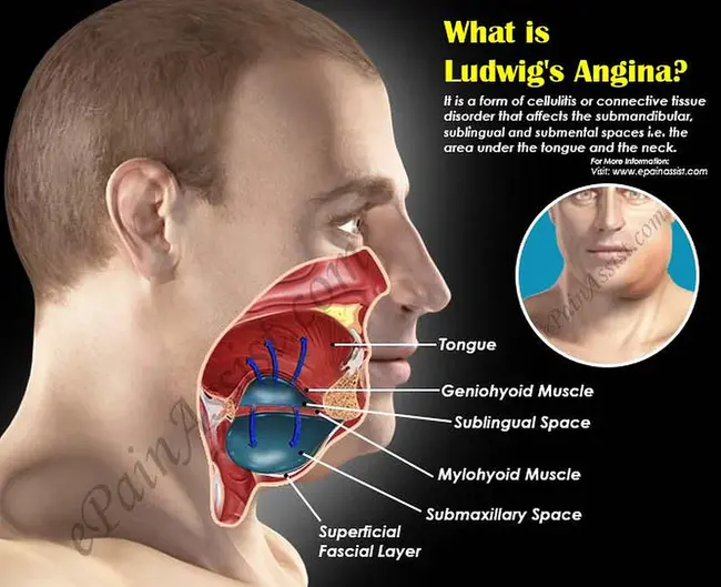 Unstable Angina Pectoris : 不稳定型心绞痛