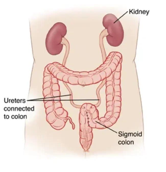 Ureterosigmoidostomy : 输尿管乙状结肠切除术