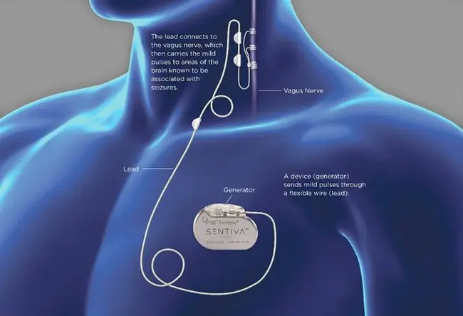 Vagal Stimulation : 迷走神经刺激