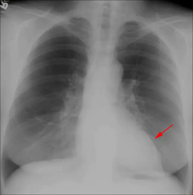 Ventricular Aneurysm : 室性动脉瘤