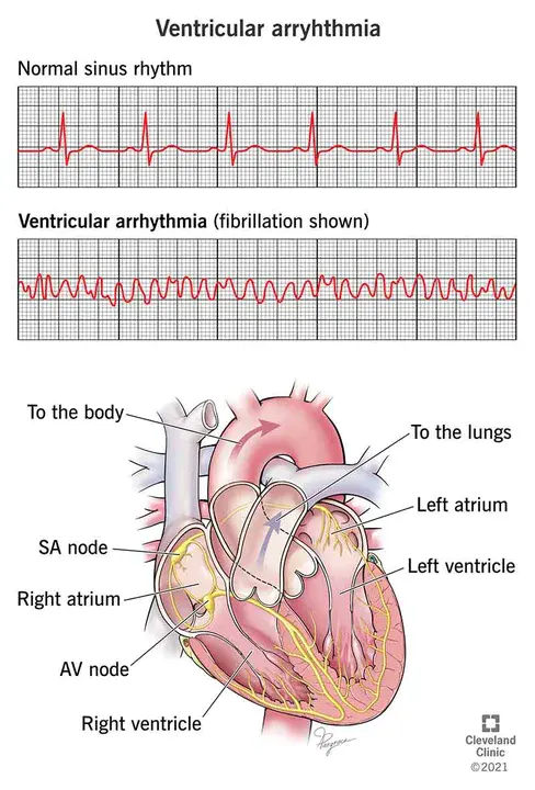 Ventricular Arrhythmia : 室性心律失常