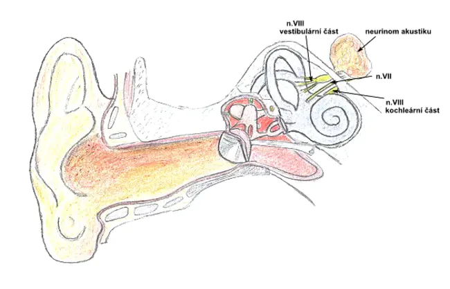 Vestibular Schwannoma : 前庭神经鞘瘤
