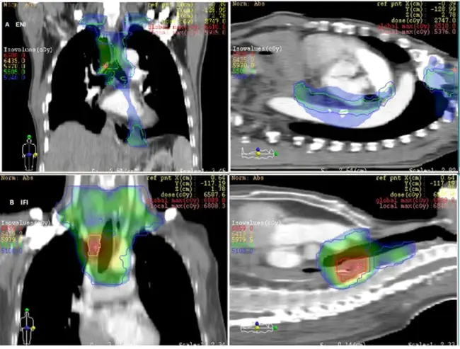 Involved-Node RadioTherapy : 受累节点放射治疗