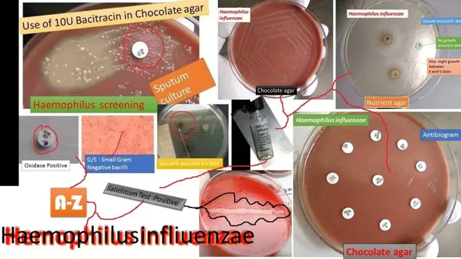 Haemophilus influenzae, invasive disease : 流感嗜血杆菌，侵袭性疾病