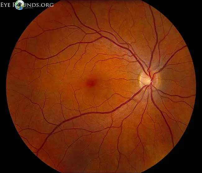 Fundus Not Discernible : 眼底无法辨认