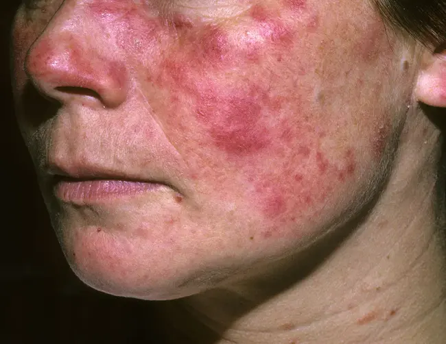 Systemic Lupus Erythematosis : 系统性红斑狼疮