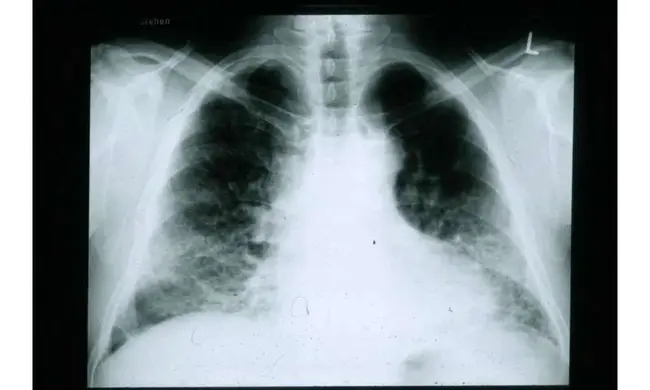 Idiopathic Cardiomyopathy : 特发性心肌病