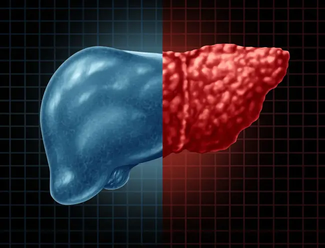 nonalcoholic steatohepatitis : 非酒精性脂肪性肝炎