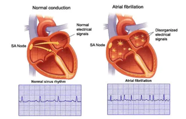 Post-atrial fibrillation : 心房颤动后