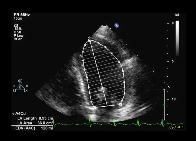 Left Ventricular End-Diastolic : 左心室舒张末期