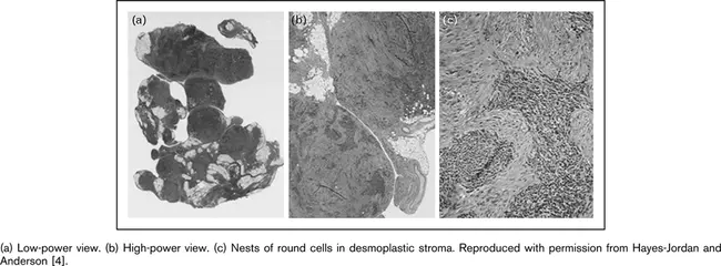 Desmoplastic Small Round Cell Tumor : 结缔组织增生性小圆形细胞瘤