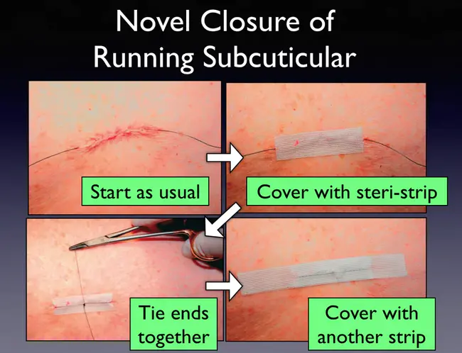 Suture-To-Off : 缝合缝合