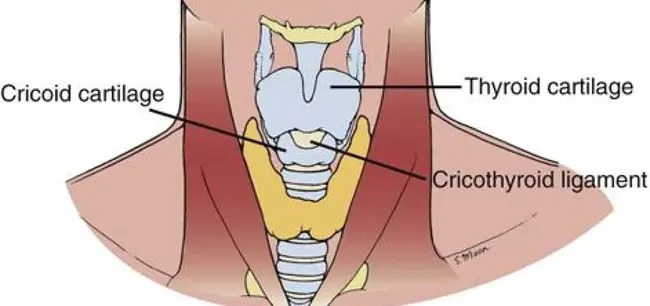 cricothyroidectomy : 环甲切除术