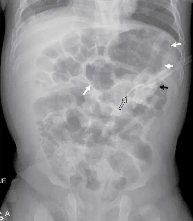 Tube Thoracotomy : 管式胸廓切开术