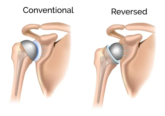 reverse electrodialysis : 反向电渗析