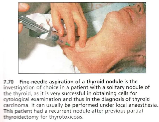 Thyroid Associated Orbitopathy : 甲状腺相关眼眶病变