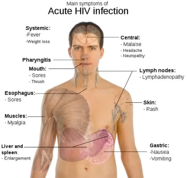 HIV-associated dementia : 艾滋病相关痴呆