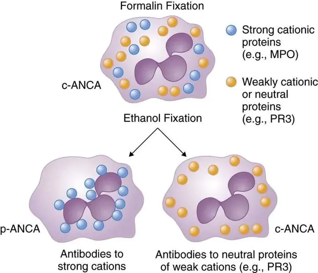 antineutrophil cytoplasmic antibodies : 抗中性粒细胞胞浆抗体