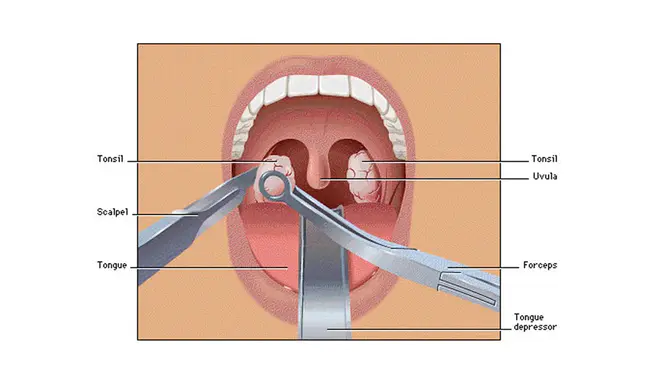 adenotonsillectomy : 扁桃体切除术