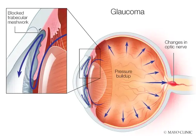 Primary Open-Angle Glaucoma : 原发性开角型青光眼