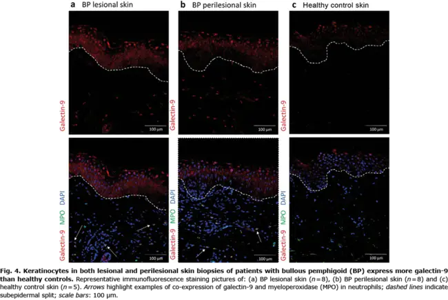 antineutrophil cytoplasmic antibody/ies : 抗中性粒细胞胞质抗体