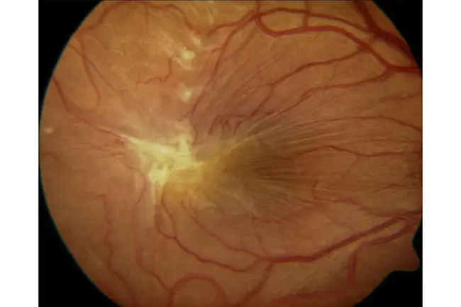 Epi-retinal membrane : 视网膜外膜