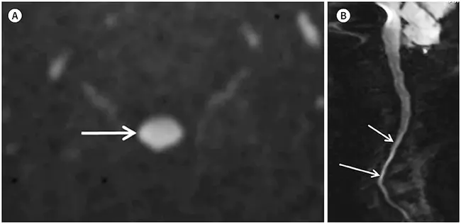 Diffusion-weighted imaging : 扩散加权成像