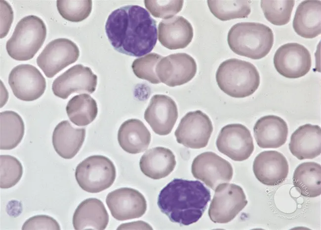 Adult T-Cell Leukemia-Lymphoma : 成人T细胞白血病淋巴瘤