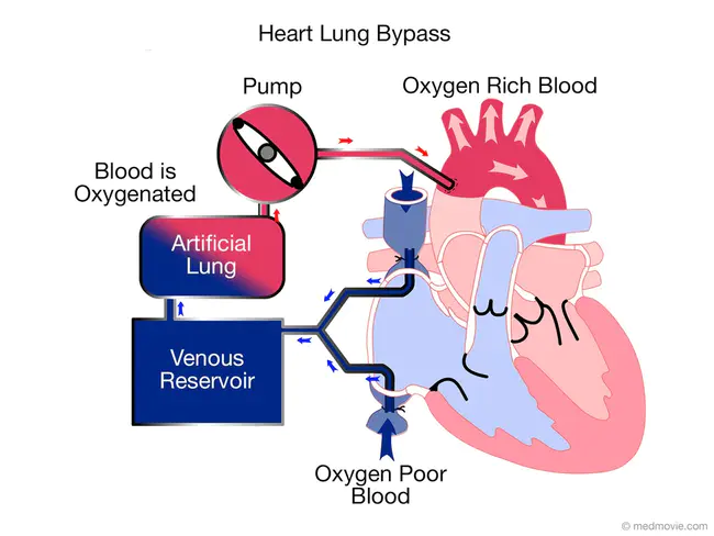 cardiopulmonary bypass : 心肺转流术