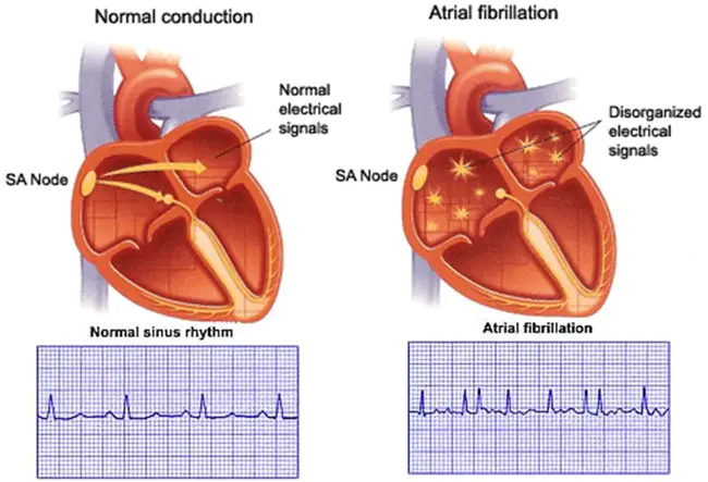 Catheter Aablation Versus Anti-arrhythmic Drug Therapy for Atrial Fibrillation : 导管消融与抗心律失常药物治疗房颤的比较