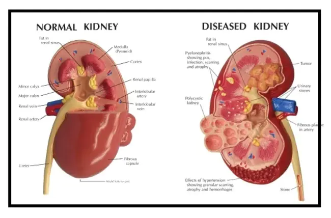 Chronic Infammatory Demyelinating Polyneuropathy : 慢性原发性脱髓鞘性多发性神经病