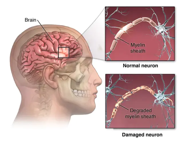 relapsing-remitting multiple sclerosis : 复发-缓解型多发性硬化