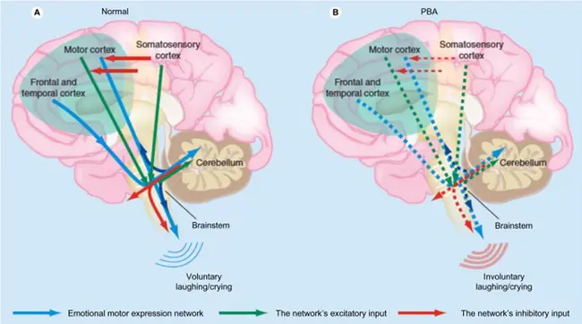 Pseudobulbar Affect : 假延髓影响