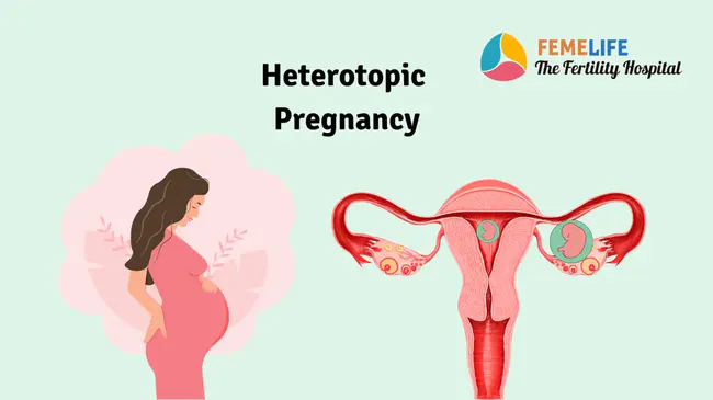 Heterotopic Pregnancy : 异位妊娠