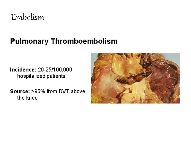 idiopathic venous thromboembolism : 特发性静脉血栓栓塞
