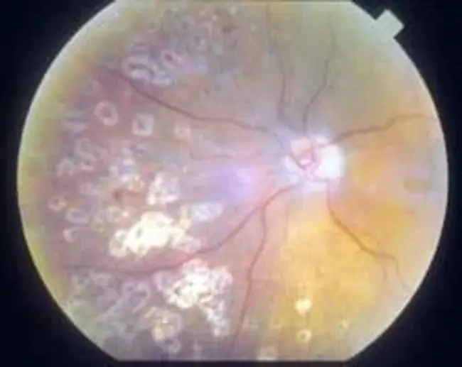 Pan-Retinal Photocoagulation : 视网膜光凝