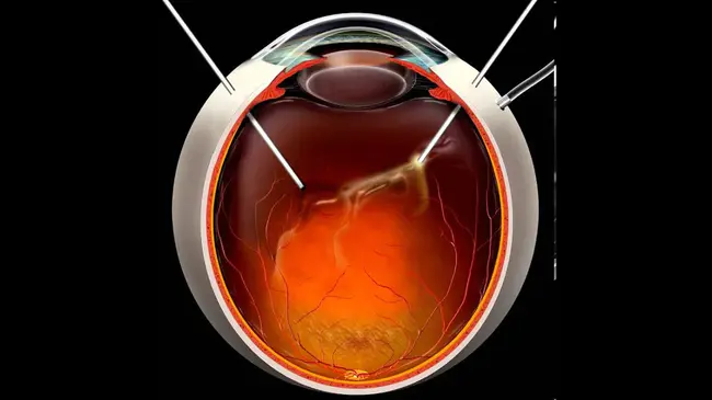 Vitrectomy : 玻璃体切除术