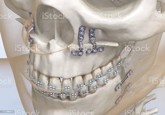 maxillomandibular advancement : 上下颌前移