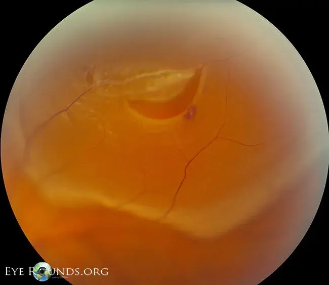 Neovascularization of the retina : 视网膜新生血管形成