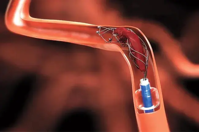 Endovascular Brachytherapy : 血管内近距离放射治疗